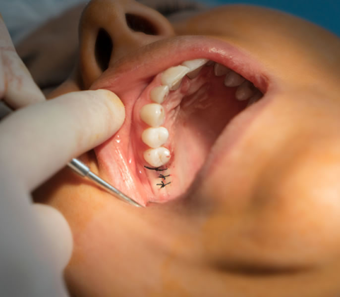 durabilidad implantes dentales