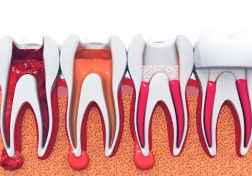 principios tratamiento endodontico